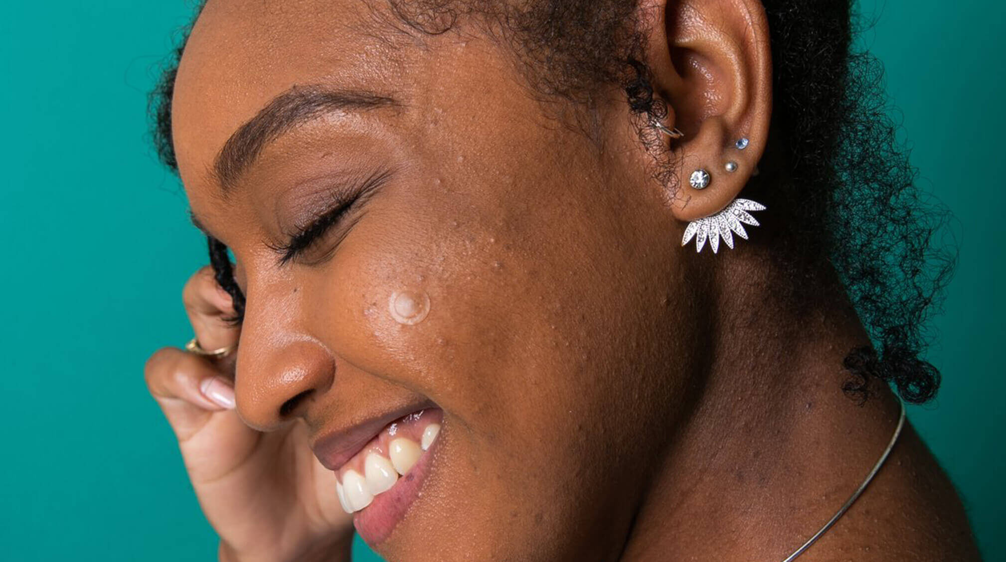 Dark skinned girl with Mighty Patch on face