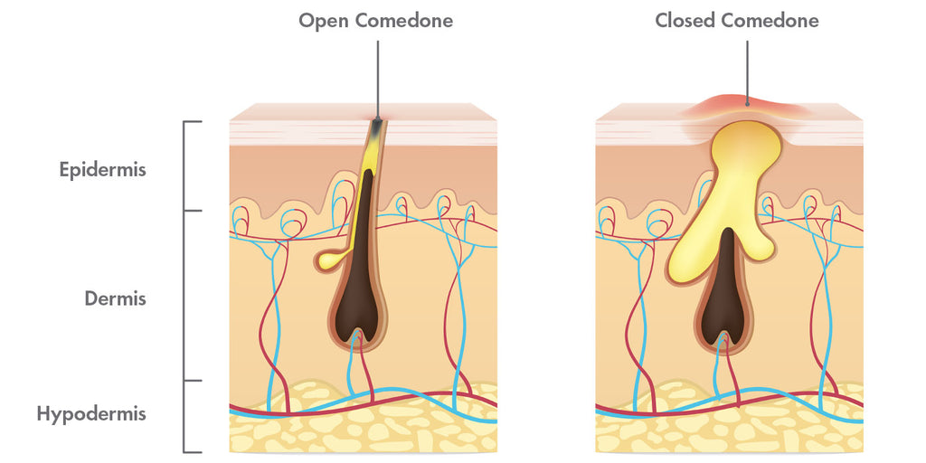 open vs closed comedone