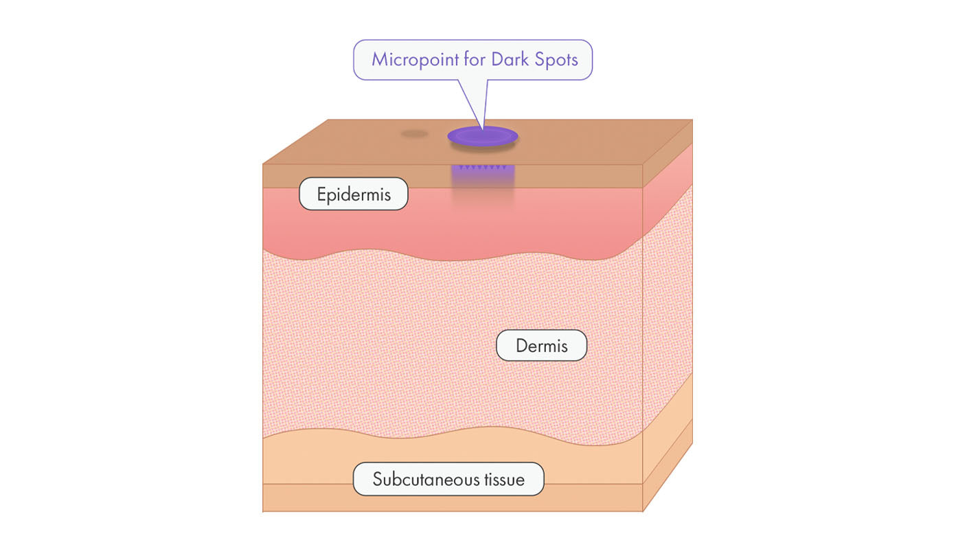 Micropoint for Dark Spots applied on hyperpigmentation graphic
