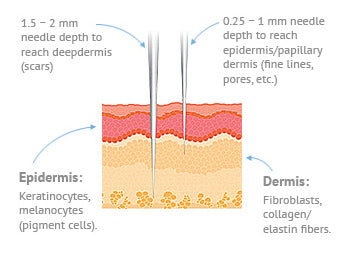 Magnified view of microneedles. 0.25-1mm reaches epidermis layer, 1.5-2mm needle reaches dermis.