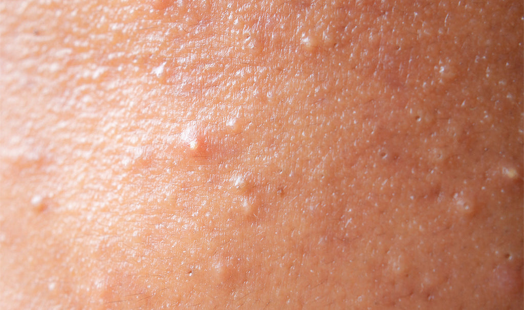 Fungal acne on forehead