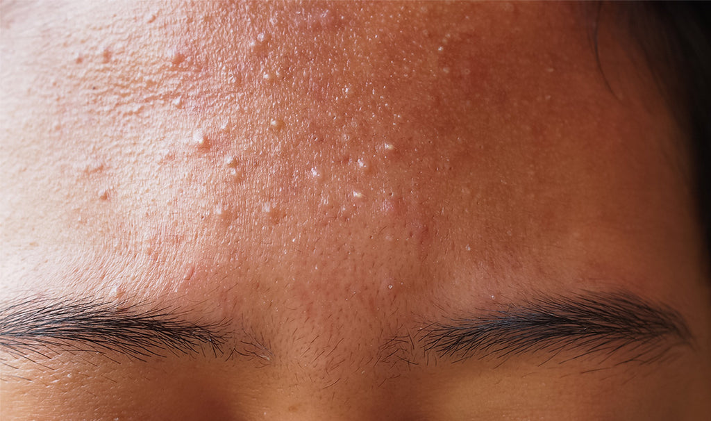 Fungal acne on forehead