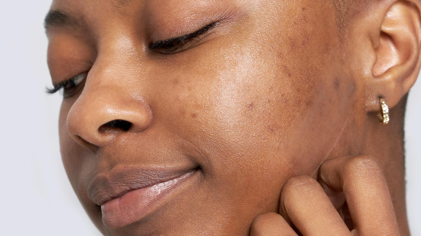 Destina with hyperpigmentation