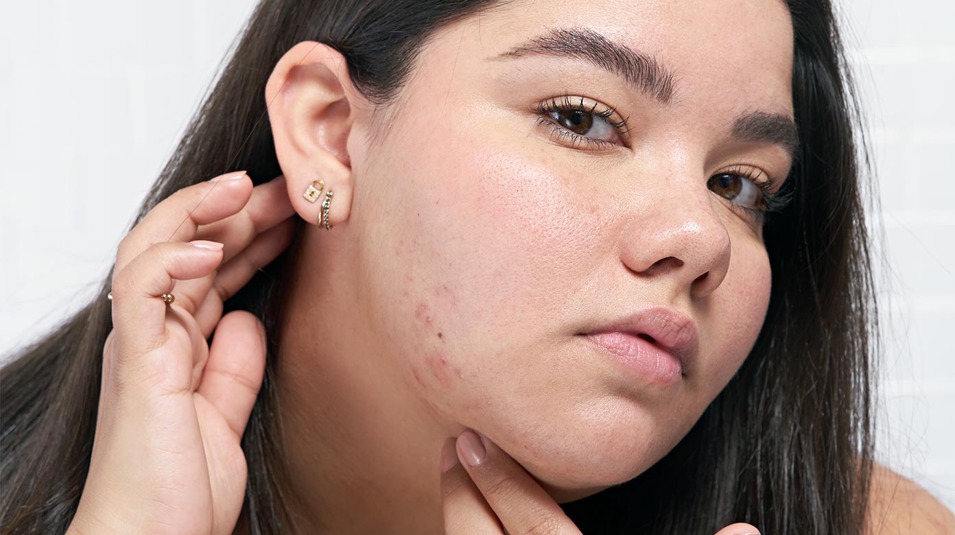 Priscilla showing hyperpigmentation
