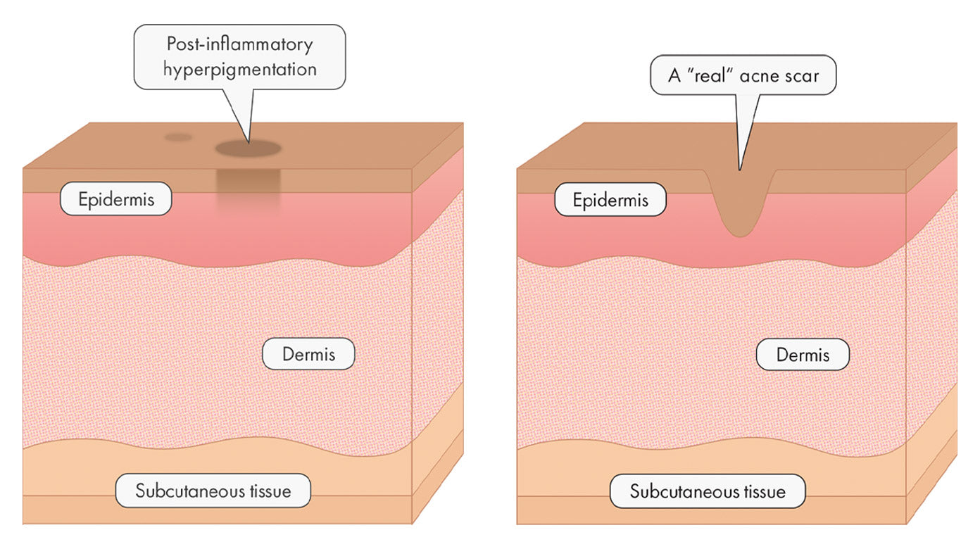 How to get rid of your acne scars post inflammatory hyperpigmentation with labels