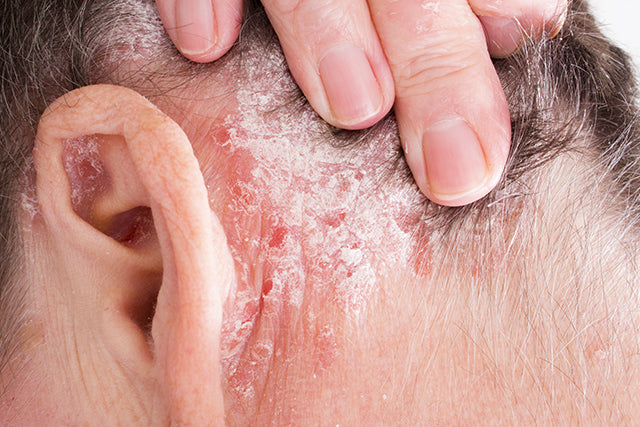 Person's neck with eczema and dryness