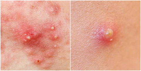 pustule
