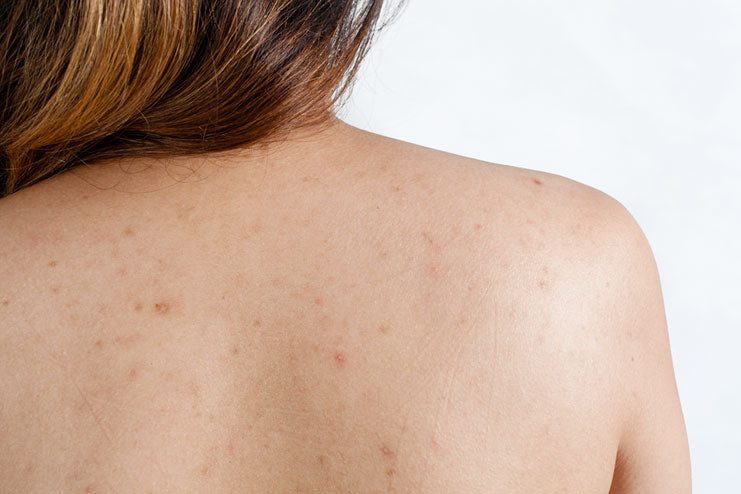 Woman with back acne