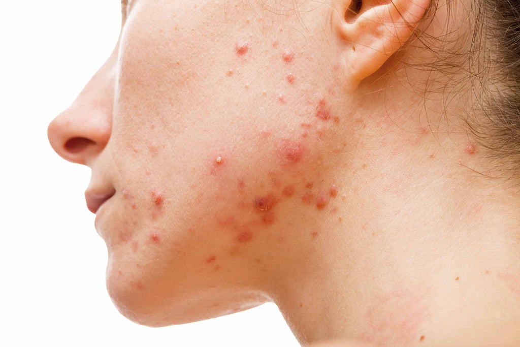 Face showing cystic acne