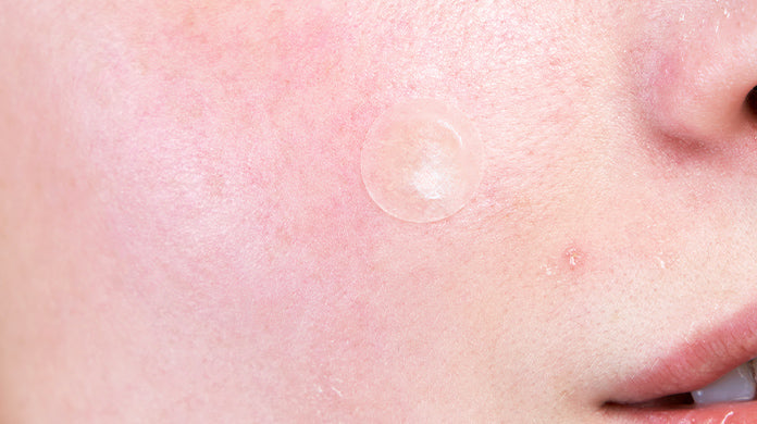 Caucasian model with redness and irritation on face