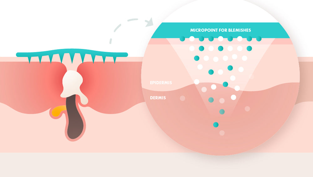 Micropoint for blemishes how it works