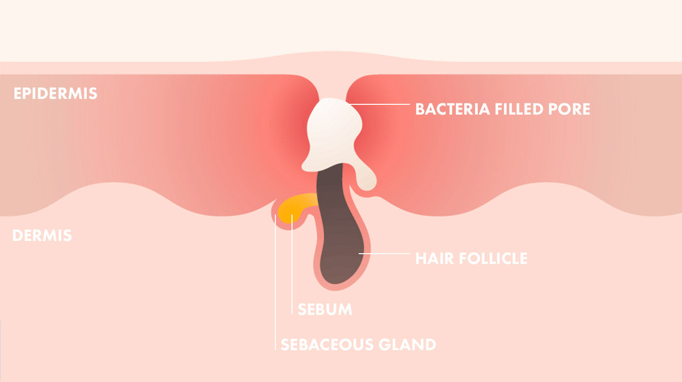 Pimple diagram