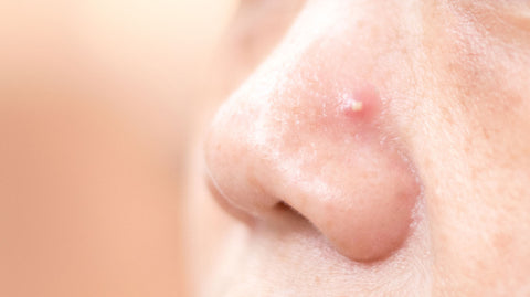 Whitehead pimple