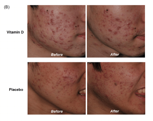 Comparison of Vitamin D Levels in Patients with and without Acne