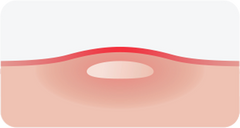whitehead pimple